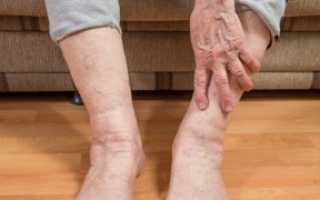 Болит кожа при варикозе