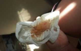 Коричневые выделения и зуд после менструации