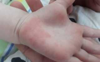 Красные ладошки, не проходящий зуд у ребенка