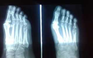 Лечение перелома 5ой пятипястной кости стопы