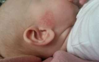 Красное пятно у мальчика 6 мес