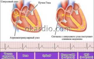 Боль в сердце при синусной брахикардии