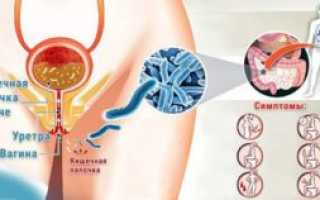 Кишечная палочка в уретре