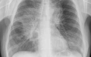 Кашель, рентген