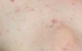 Петехиальная сыпь