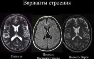 Кистозно расширенная полость Верге