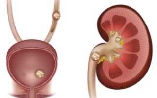 Каликоэктазия обеих почек. Беременность