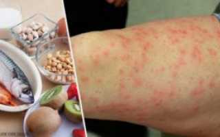 Пищевая и лекарственная аллергия у пожилого человека. Sos!