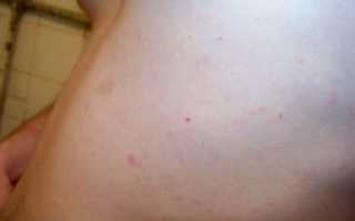 Маленькие красные точки на теле