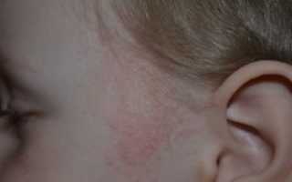 Красное шершавое пЯтно около уха, сыпь на щечках