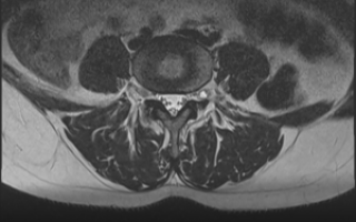 Боли в пояснице и ноге после удаления невриномы позвоночника