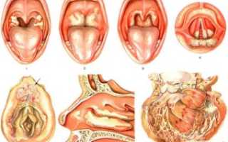 Макрота в горле после еды, осип голос