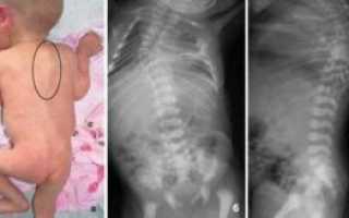 Хруст позвоночника у трехмесячного ребенка