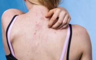 Красная сыпь/головная боль