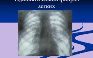 Идиопатический фиброз легких