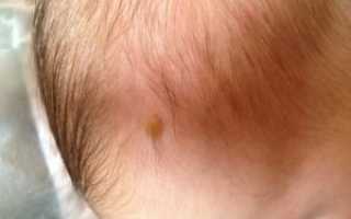 Мелкие коричневые образования на голове у ребёнка