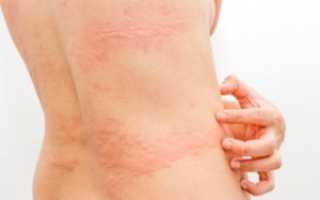 Как вылечить крапивницу и может ли она пройти сама?