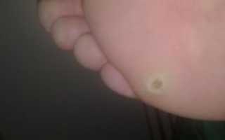 Болячка на ступне