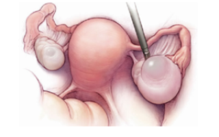 Киста на левом яичнике, объясните правильное ли у меня лечение