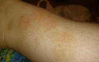 Коричневые пятна на икрах ног