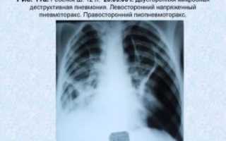 Левосторонняя пневмония без динамики