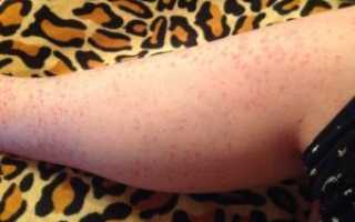 Красная сыпь на ноге