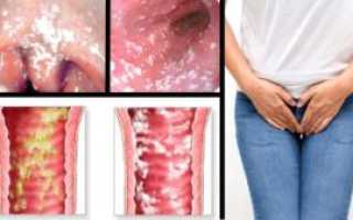 Как предотвратить молочницу после бассейна