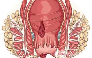 Кровь из анального отверстия после тренировок по бодибилдингу