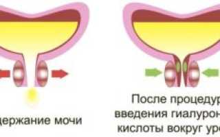 Лечение недержания гиалуроновой кислотой