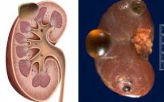 Киста в почке и анализы