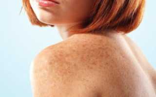 Пигментные пятна на теле