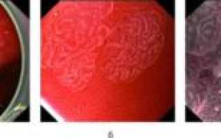 Кишечная метаплазия, эрозивно-язвенный дефект