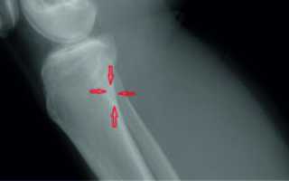 Киста большеберцовой кости у девочки 13 лет