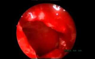 Кровь после гайморотомии