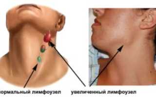 Боль в трахее увеличение лимфоузлов