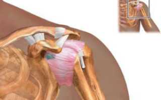 Лопнула суставная капсула