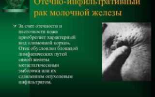 Инфильтративные изменения молочной железы