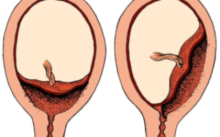 Матка низко