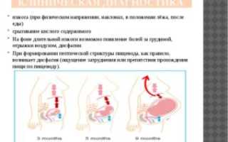 Изжога лёжа