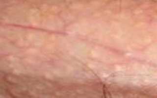 Киста на головке полового члена, подскажите метод лечения