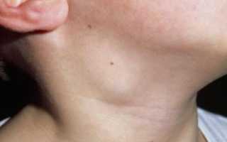 Лимфоузлы при кариесе