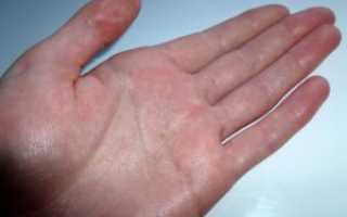 Болит кожа на ладонях рук