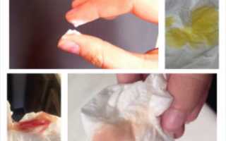 Кровянистые выделения при лечении свечами Макмирор