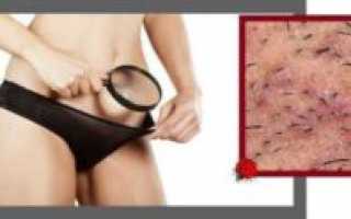 Какие анализы сдать при зуде в интимной зоне