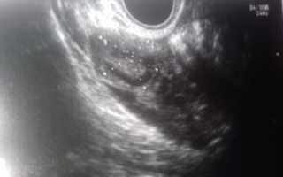 Киста или ЖТ