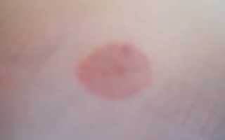 Красные, круглые пятна на нонах и руках, не чешутся