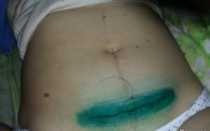 Болит послеоперационный шов