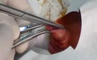 Как остановить кровотечение после обрезания