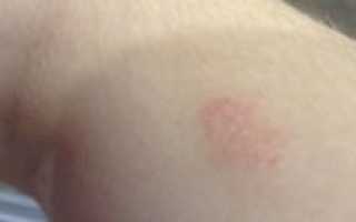 Красное шершавое пятно на бицепсе