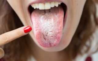 Klebsiella pneumoniae 10*5 степени весь рот обложен белым налетом очень болит